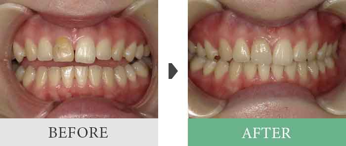 オールセラミック症例1