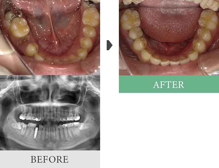 インプラント症例1