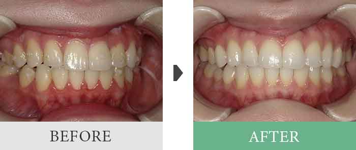 ホワイトニング症例1