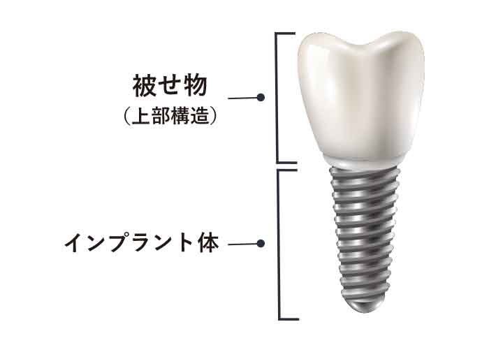 ガイドデントのインプラント保証