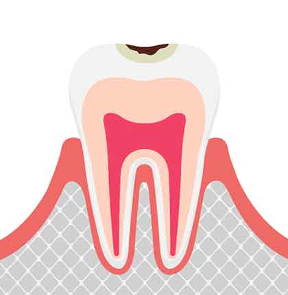 C1エナメル質に達するむし歯
