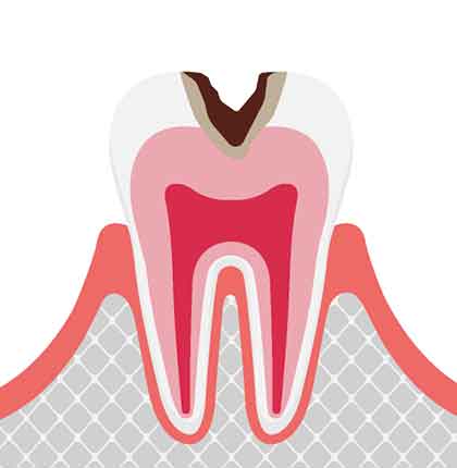 C2 象牙質に達するむし歯