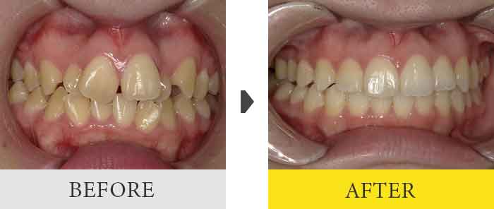 インビザライン症例1