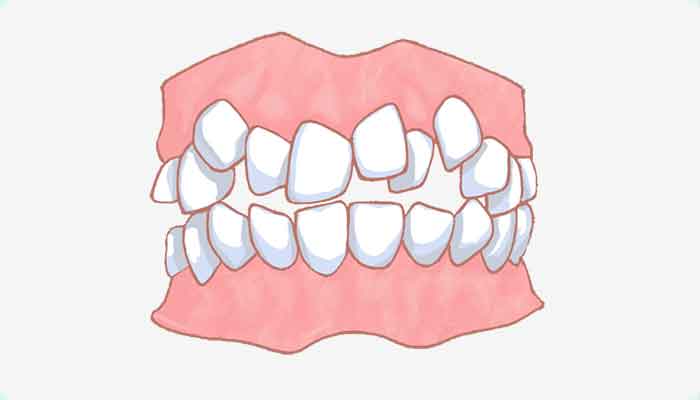 乱ぐい歯（叢生）