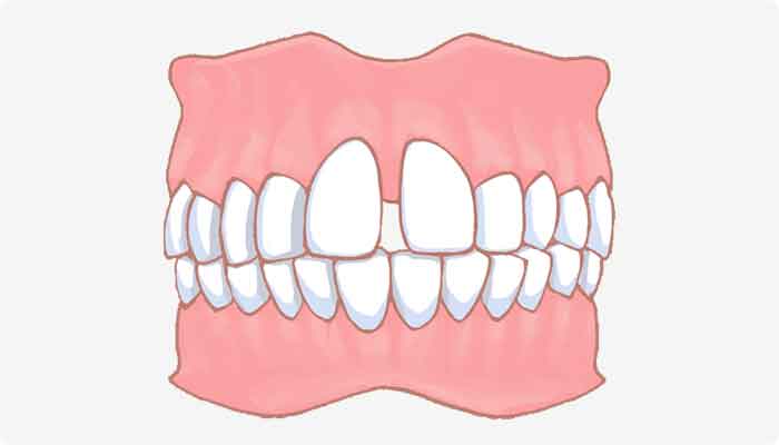 すきっ歯（空隙歯列）